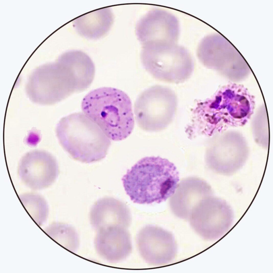Plasmodium vivax stained blood smear
